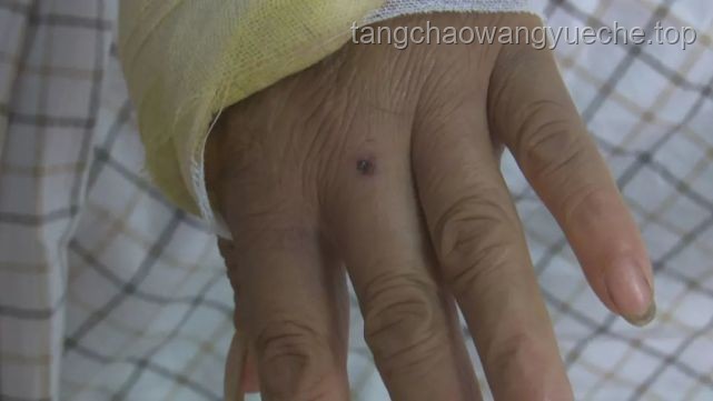 男子被蝮蛇咬伤全市寻适配血清案研究